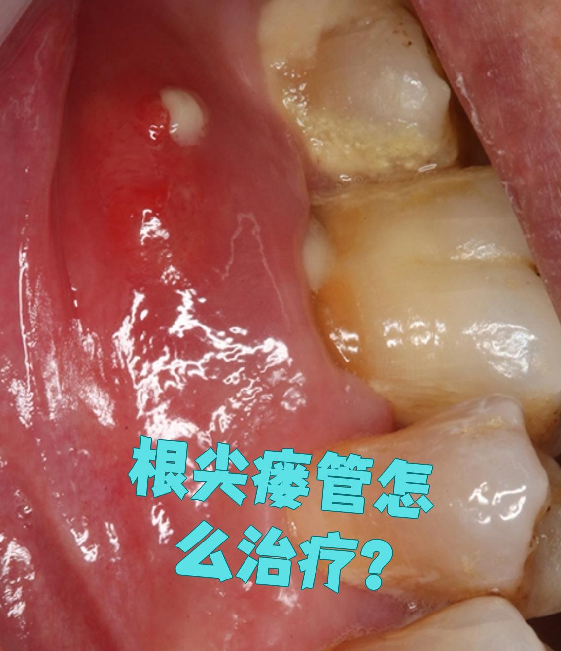 根尖瘘管说明牙齿有慢性根尖周炎