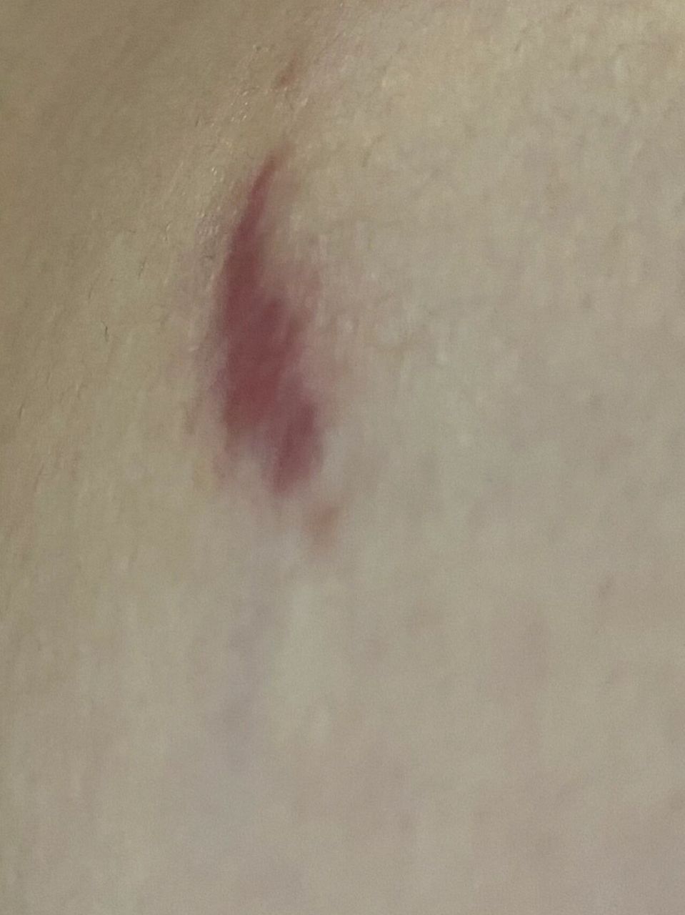 疤痕增生,乳腺纤维瘤手术后 姐妹们,能给我看一下,我这是疤痕增生了吗