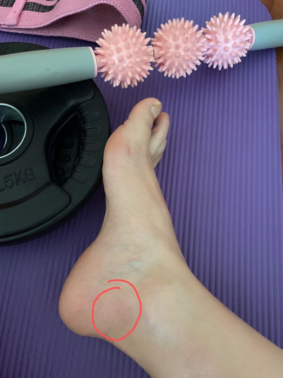 运动完脚踝内侧疼 连续运动一个月 这两天脚裸处突然疼痛 有没有小