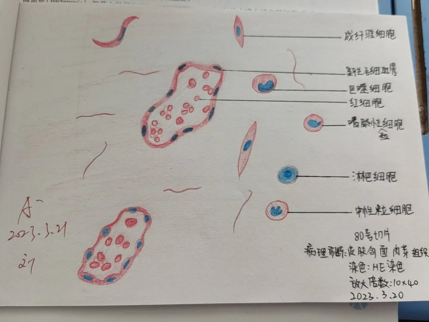 病理学红蓝铅笔绘图 肉芽组织绘图 炎细胞绘图 炎症病案讨论 动脉粥样