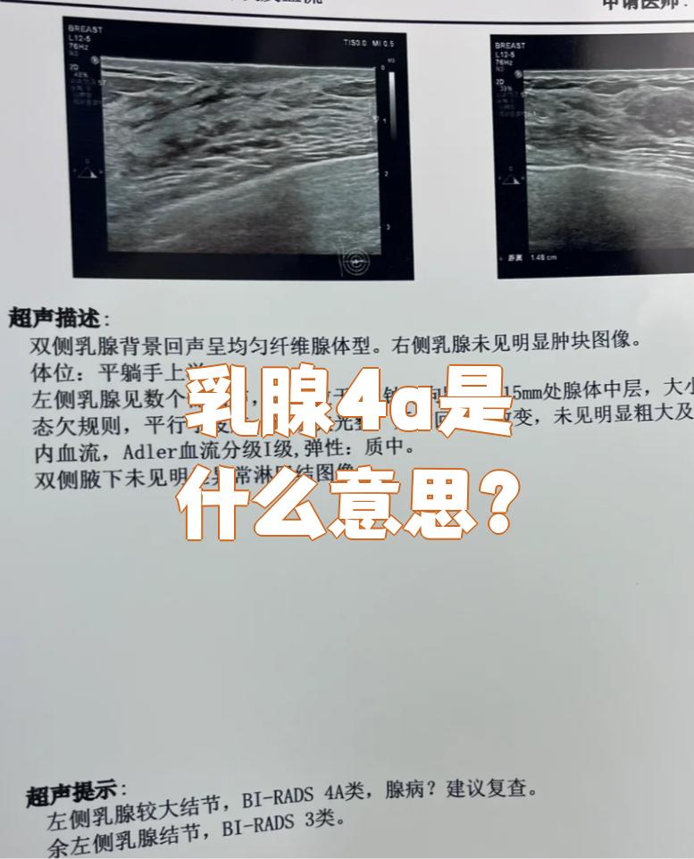 乳腺4a是乳腺检查中对肿物恶性风险的一种评估分类