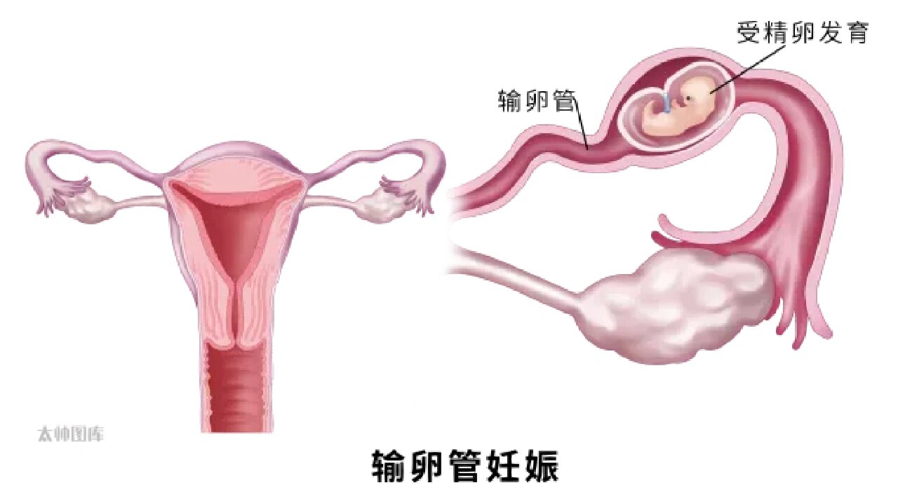 异位妊娠图片部位图片