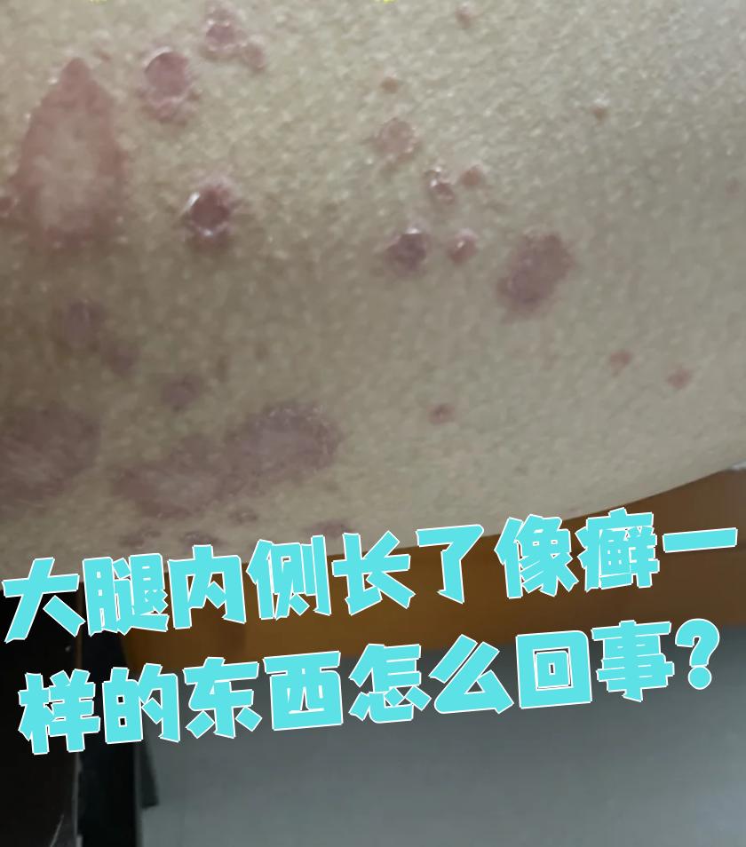 症状多出现在腹股沟,臀部这些地方,皮肤会出现环形红斑或丘疹.治疗可