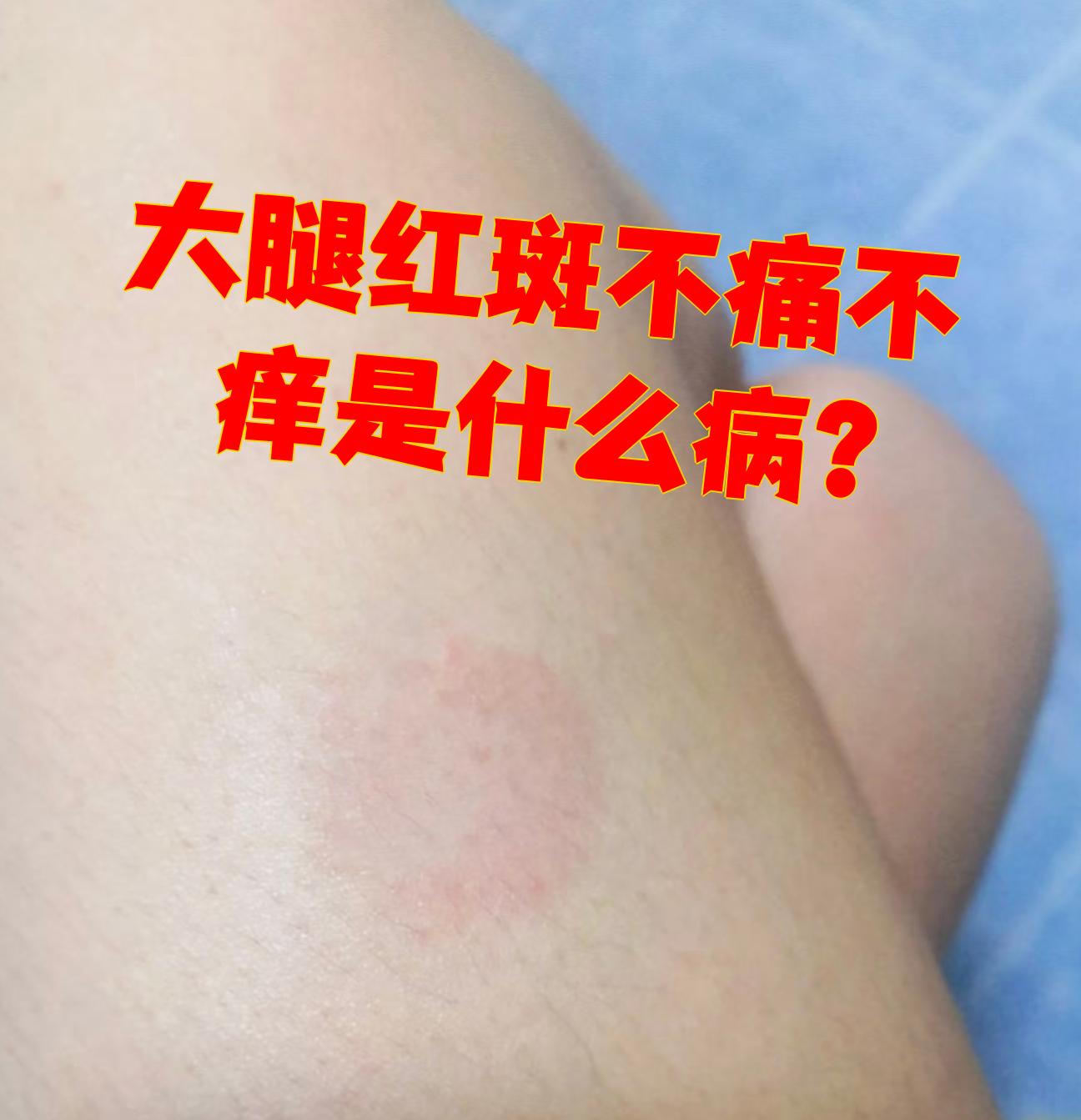 日光性皮炎:由于太阳光刺激皮肤所致,通常出现在曝光部位,如腿部和