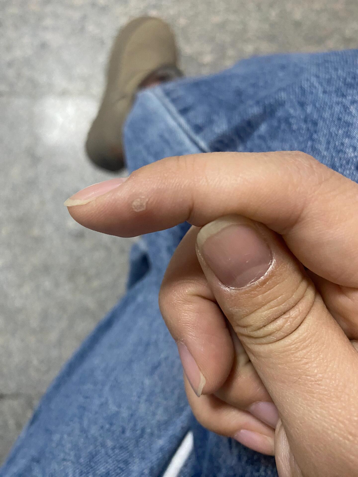 手指头长了一个疙瘩