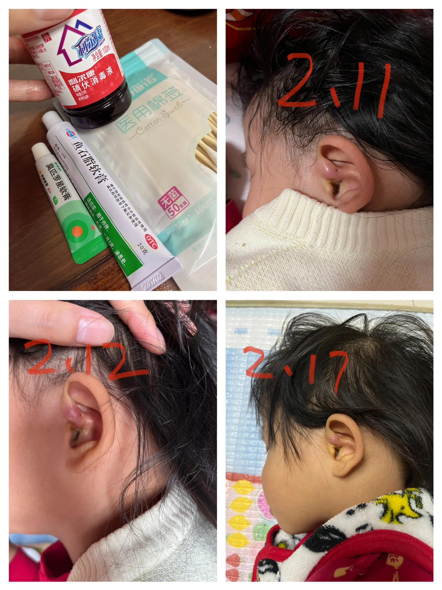 耳瘘管突然发炎了,怎么处理