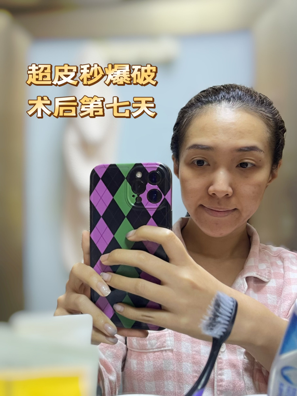 原相机无美颜无滤镜记录超皮秒爆破恢复过程 [期待]今天距离超皮秒