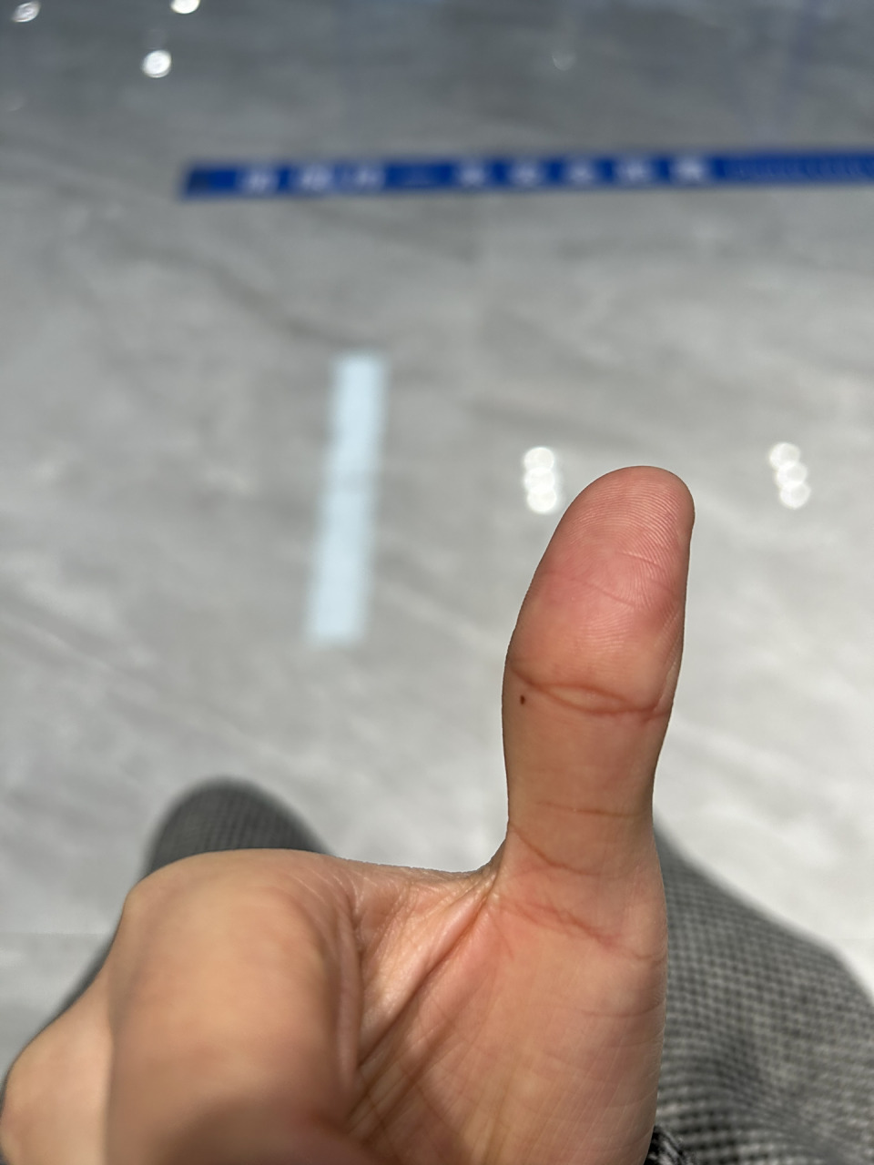 最近发现大拇指突然长出一个黑痣