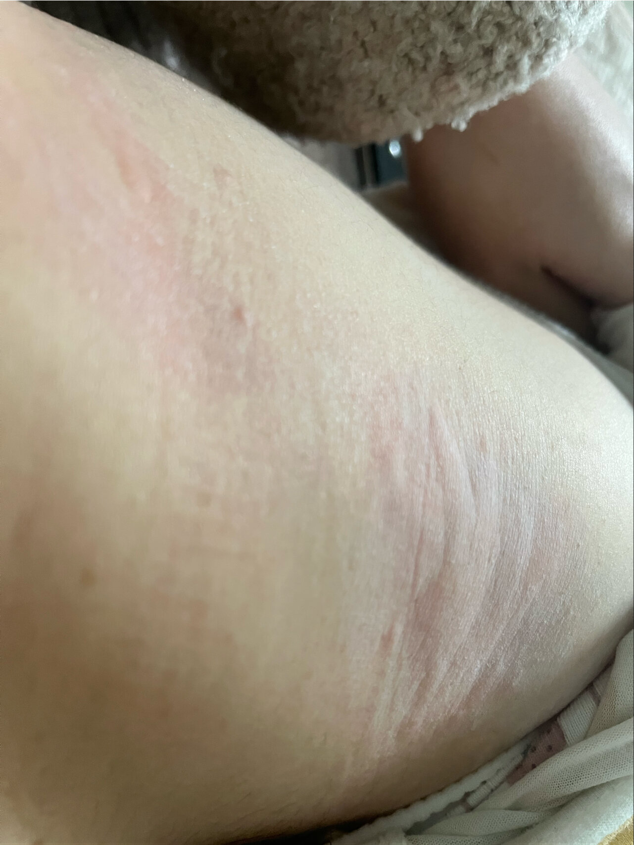【急性荨麻疹性血管炎】住院前记录 94吃了治疗幽门螺旋杆菌的一线