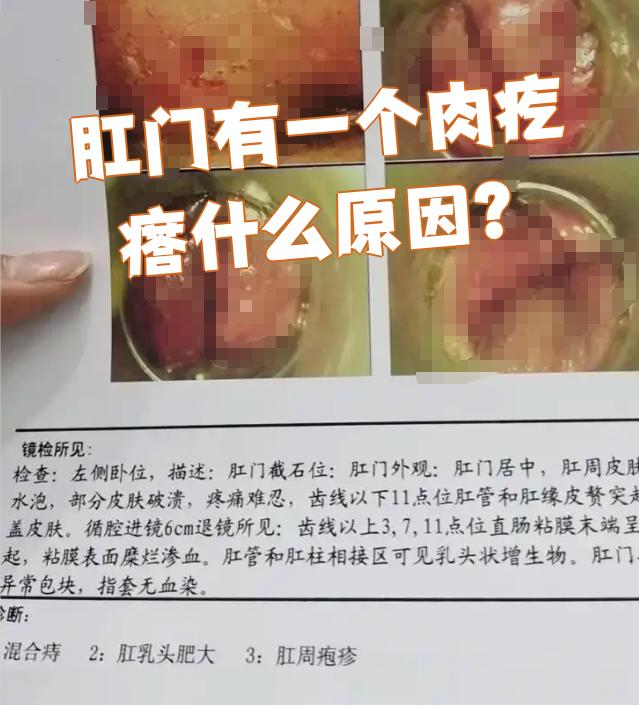 肛门长了个肉疙瘩,最常见的原因是痔疮,直肠息肉,肛乳头瘤或尖锐