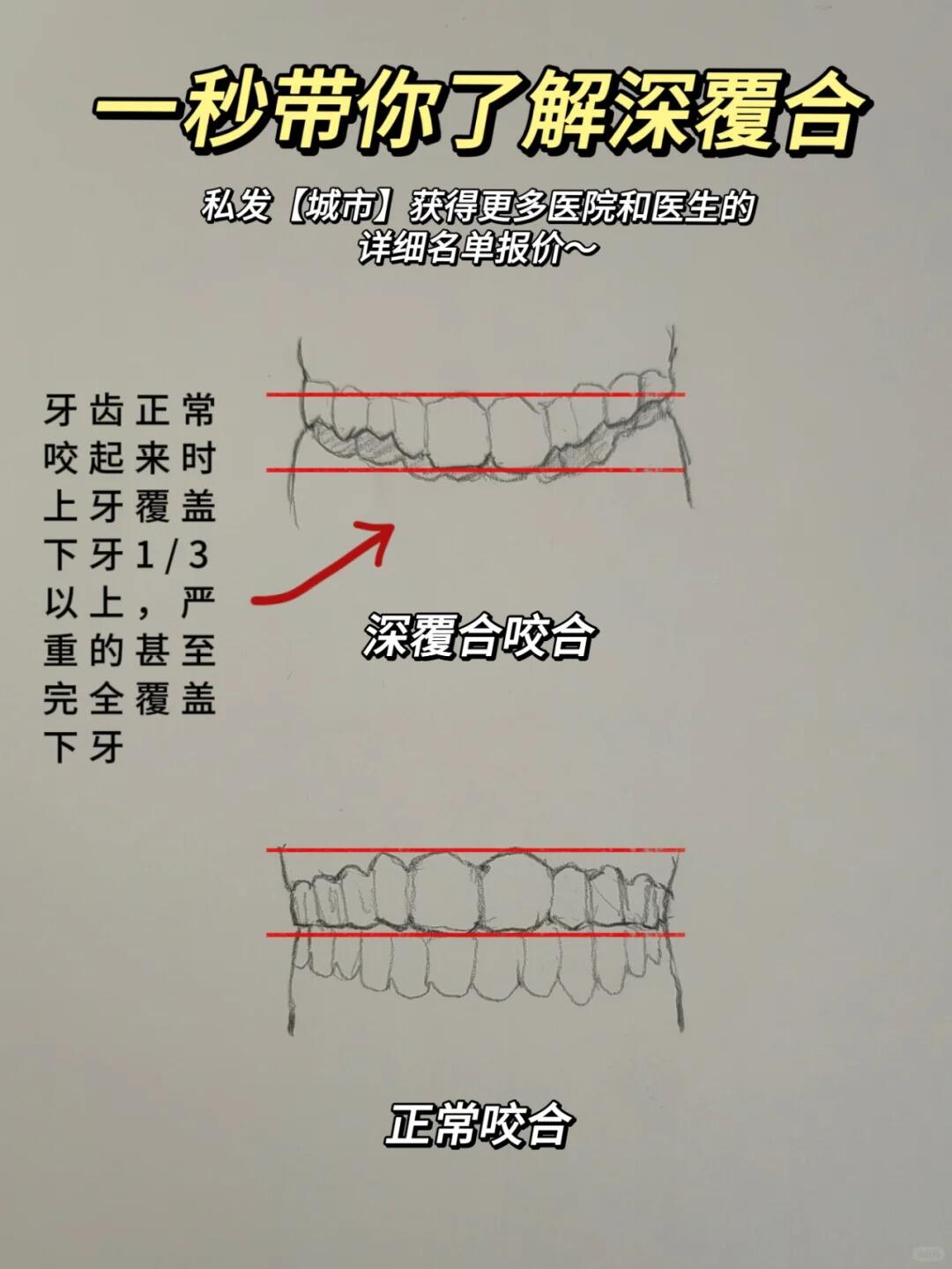 牙齿深覆合面相图片