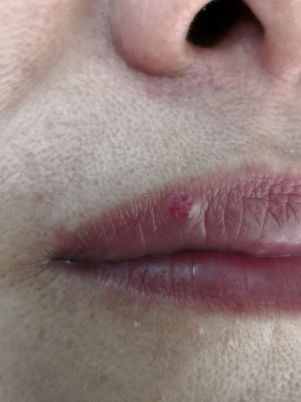 考虑化脓性肉芽肿#激光美容# 可以使用激光治疗去除#化脓性肉芽肿