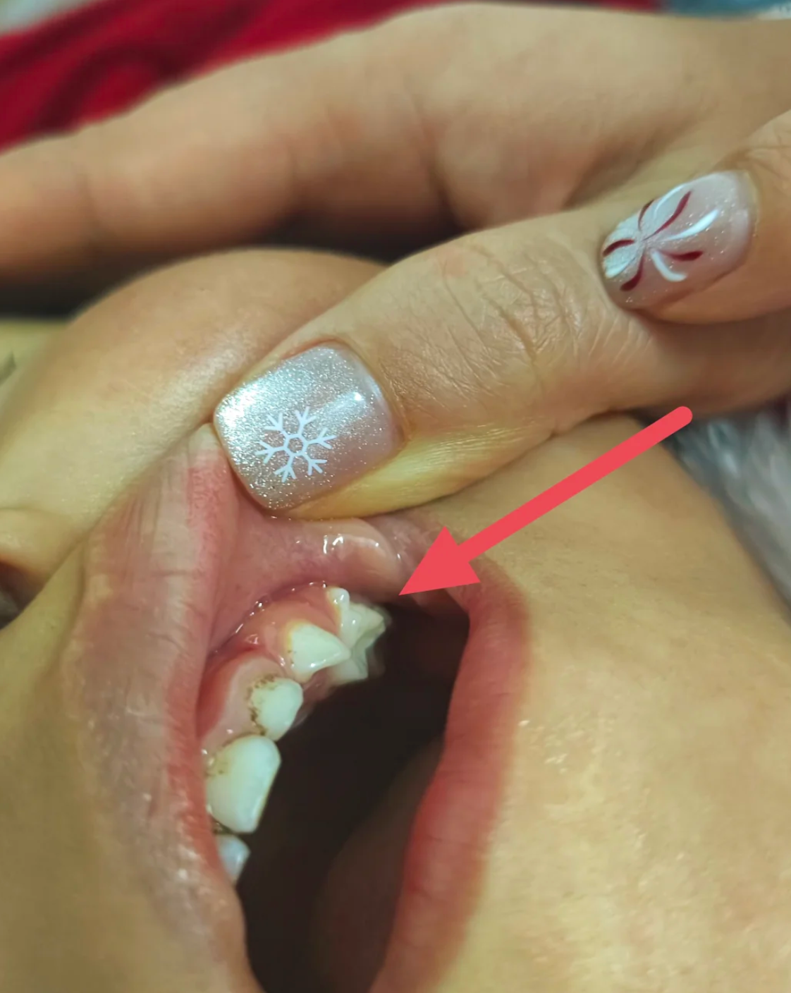 上牙后面又长了一颗牙,最常见的是智齿,也可能是多生牙