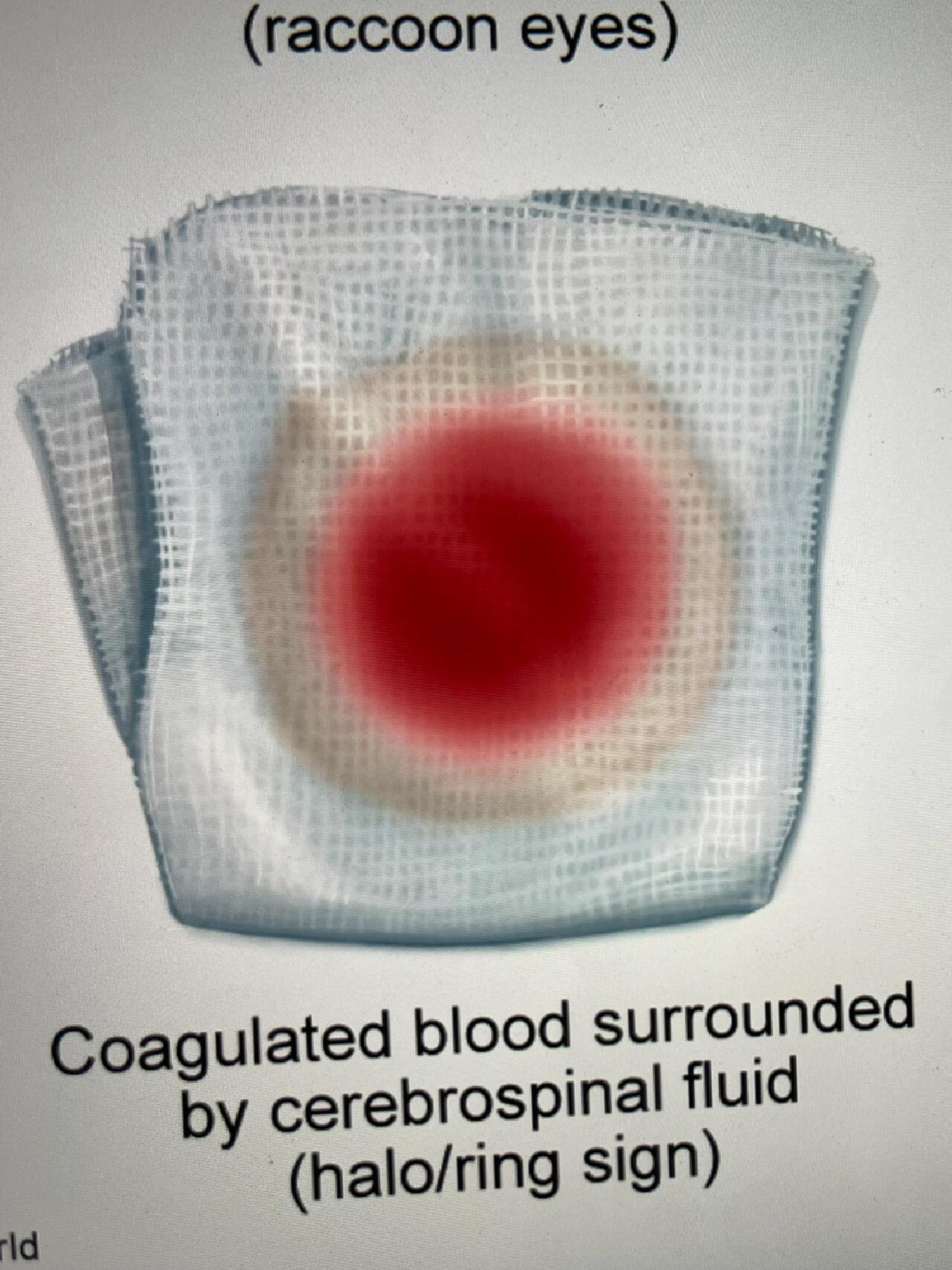 rn考试之颅底骨折 一目了然的考点 熊猫眼 耳鼻脑脊液漏(halo sign)