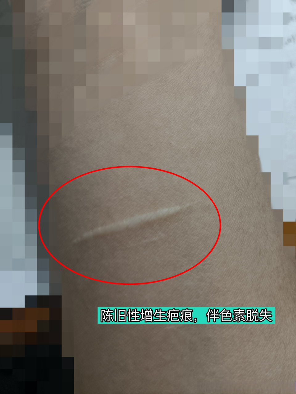增生性疤痕伴有色素脱失,时间越久激光修复效果越差.