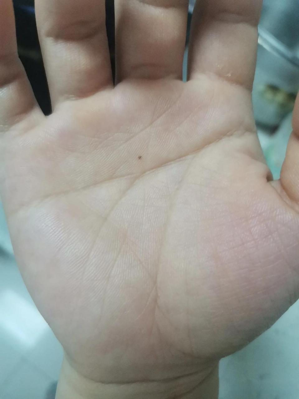 痣和手掌纹路会变.