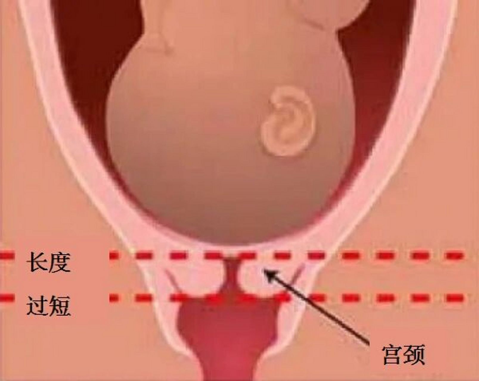 宫颈长度怎么检查图片