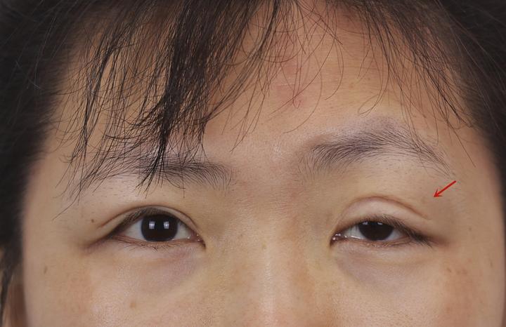 东北姑娘左眼眼睑下垂做了3次矫正还是不好来找我们修复