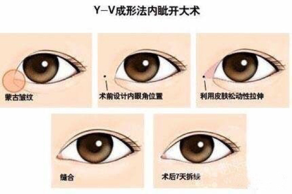 99697115科普|内眼角开过大6015等回缩90or修复90