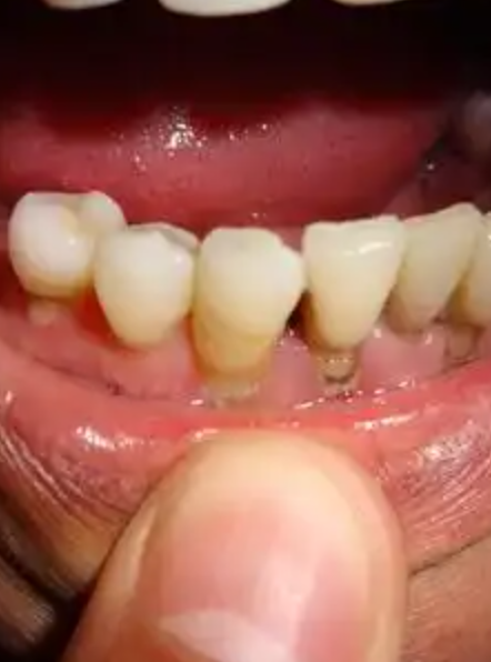 糖尿病人牙齿松动通常是糖尿病的并发症之一