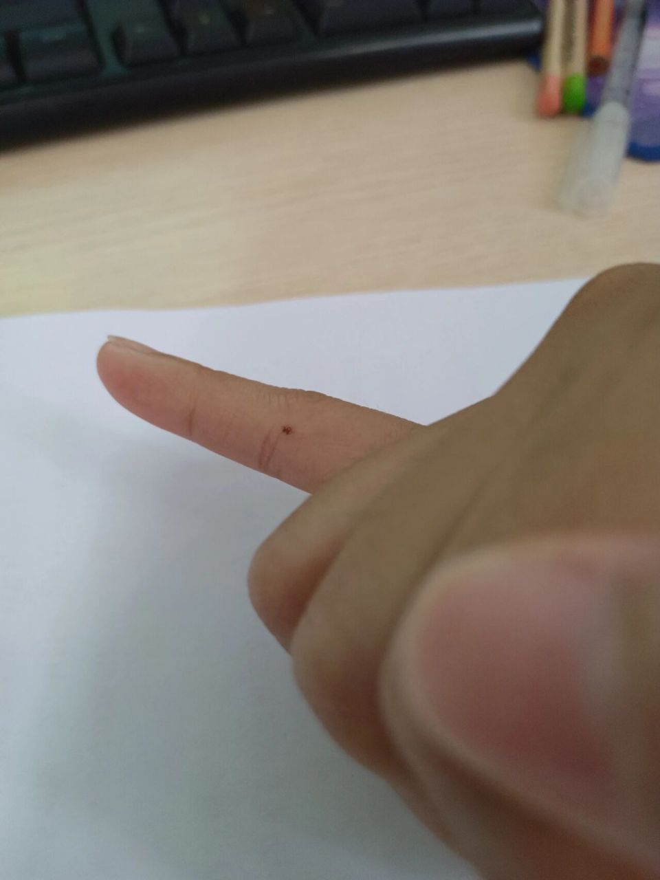 小拇指突然长了个痣
