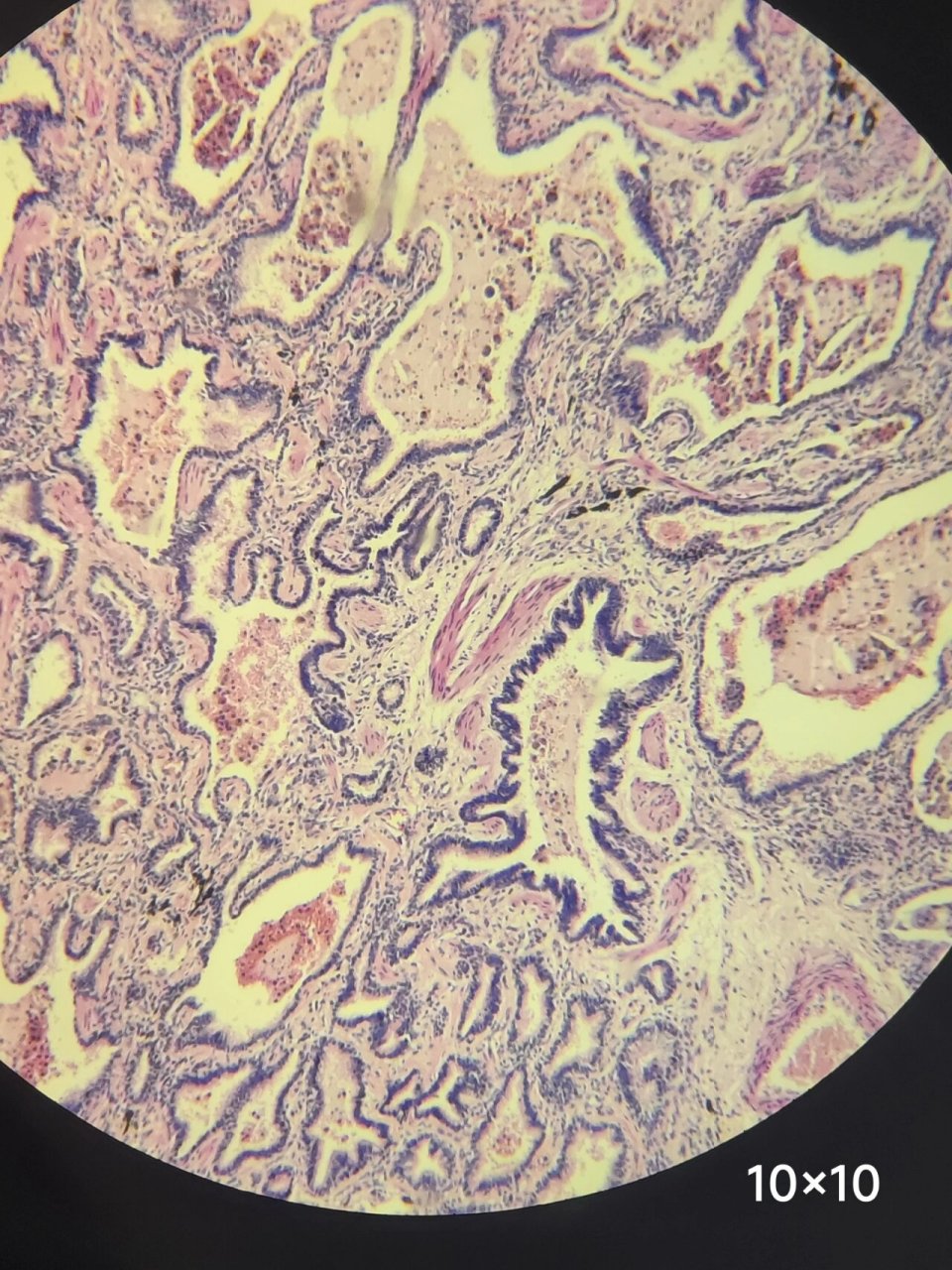 慢性肺淤血光镜下结构. 慢性肺淤血