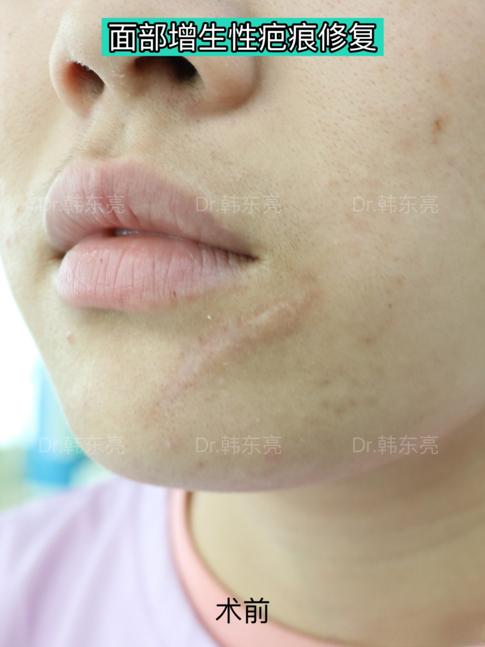 【面部陈旧性增生疤痕修复】 患者嘴巴下方的增生性疤痕比较长,凸起