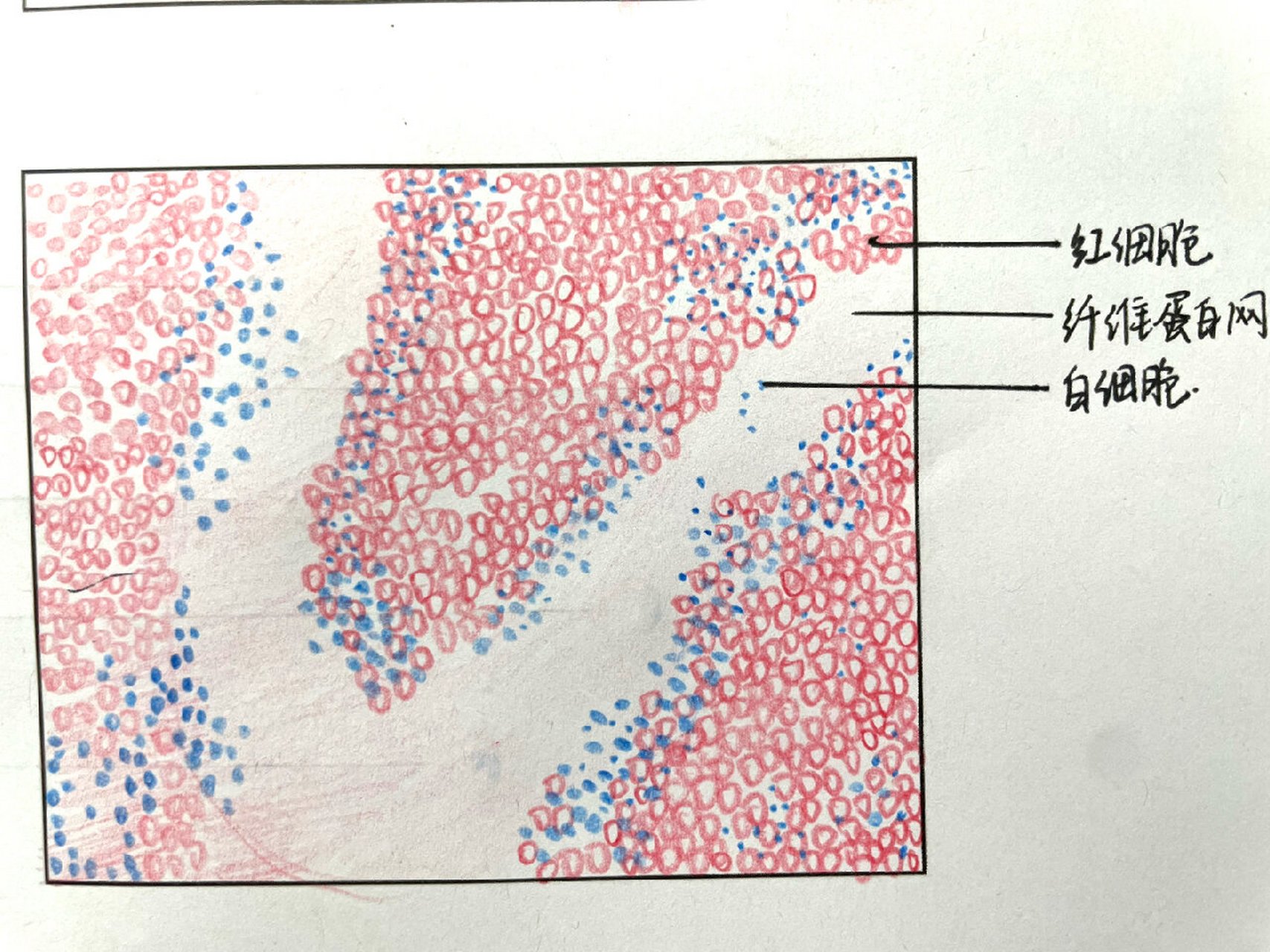 病理学手绘切片分享 p2:慢性肺淤血 肺泡壁画了毛细血管和一,二型肺泡