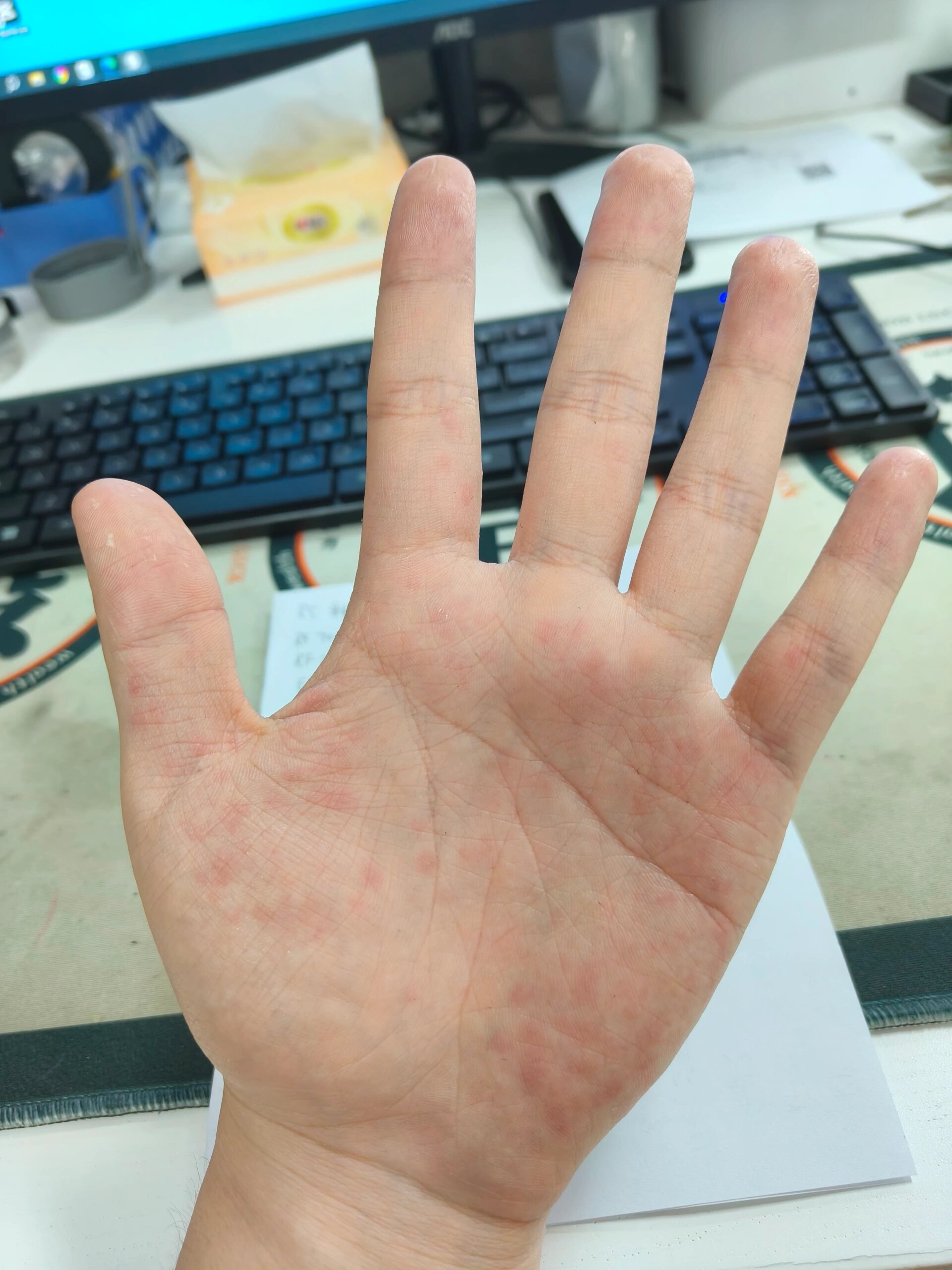 手掌出汗还有红点点微痒微痛
