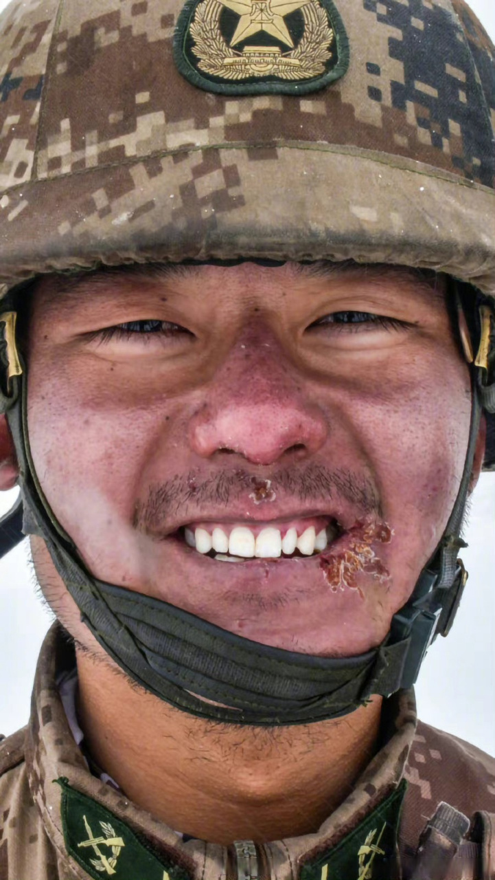 一张边防战士的照片,由于风吹日晒,皮肤黝黑,脸上已经起皮,嘴角还有了