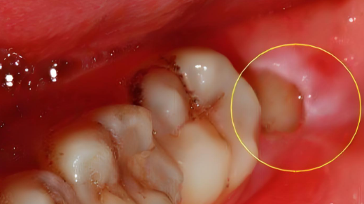 成年后长牙齿,通常是由智齿萌出,多生牙生长