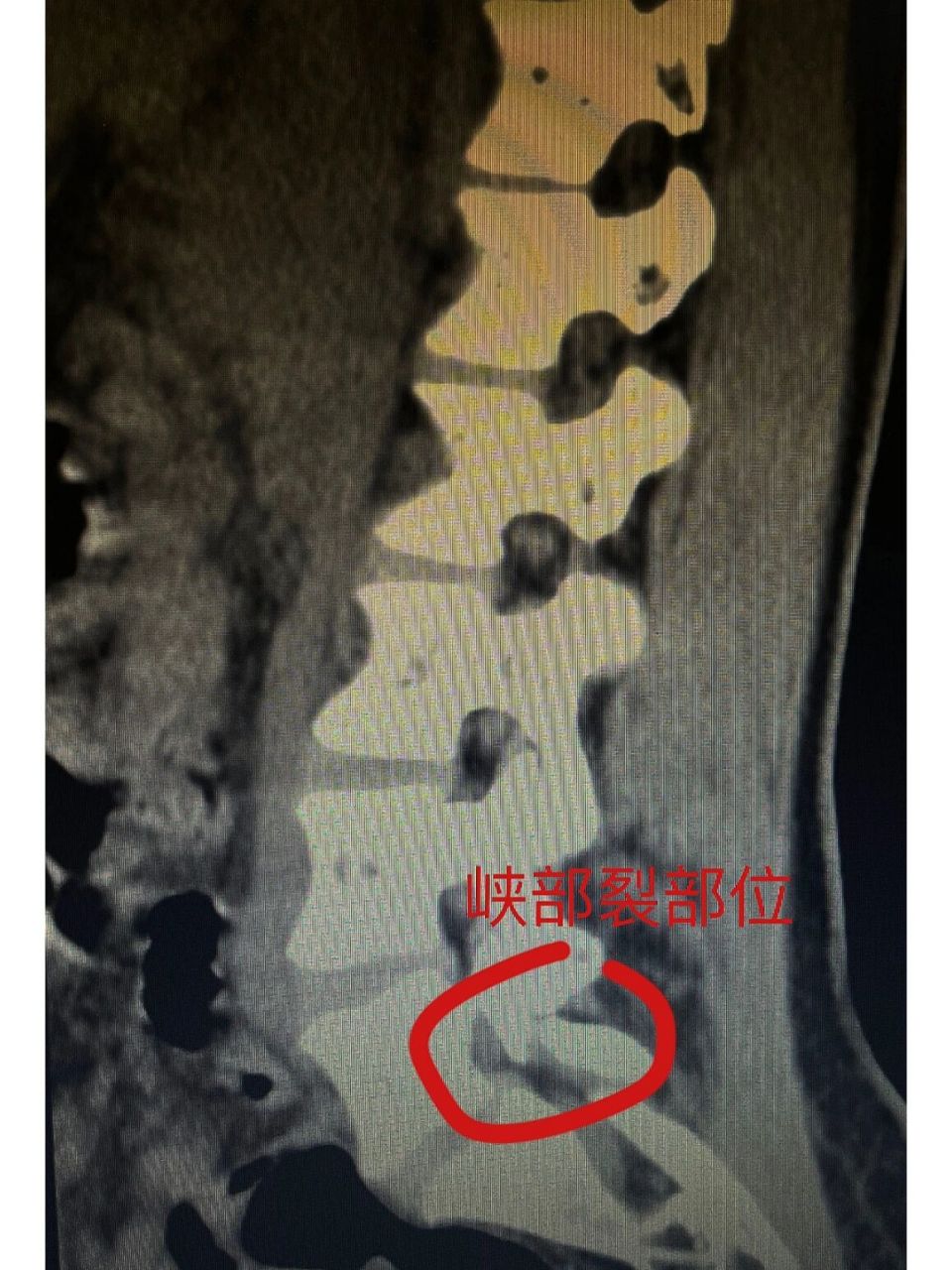 脊柱裂核磁图片