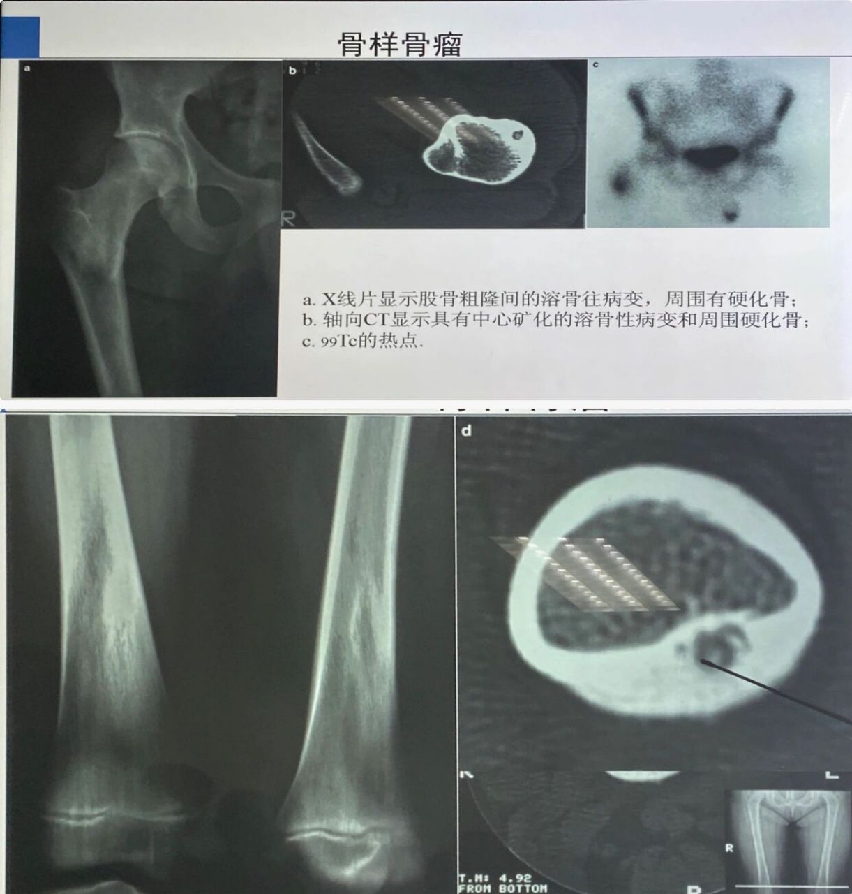 骨样骨瘤x线表现(图)图片