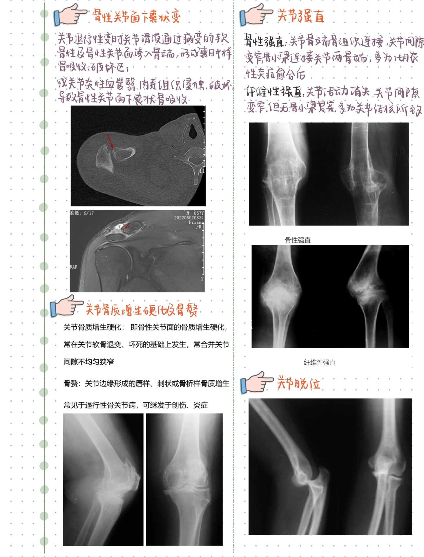 骨桥形成图片