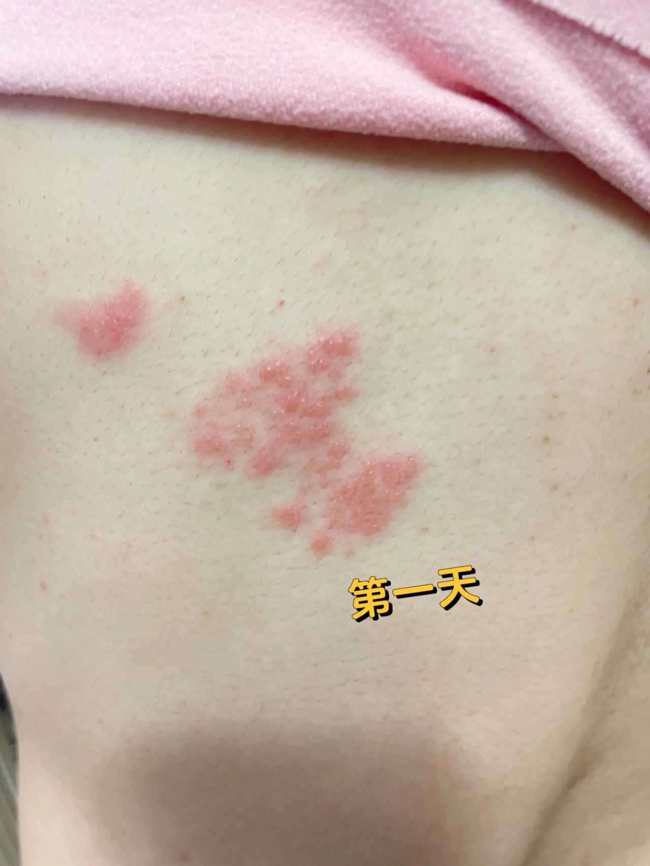 哺乳期起疱疹,宝宝才70天