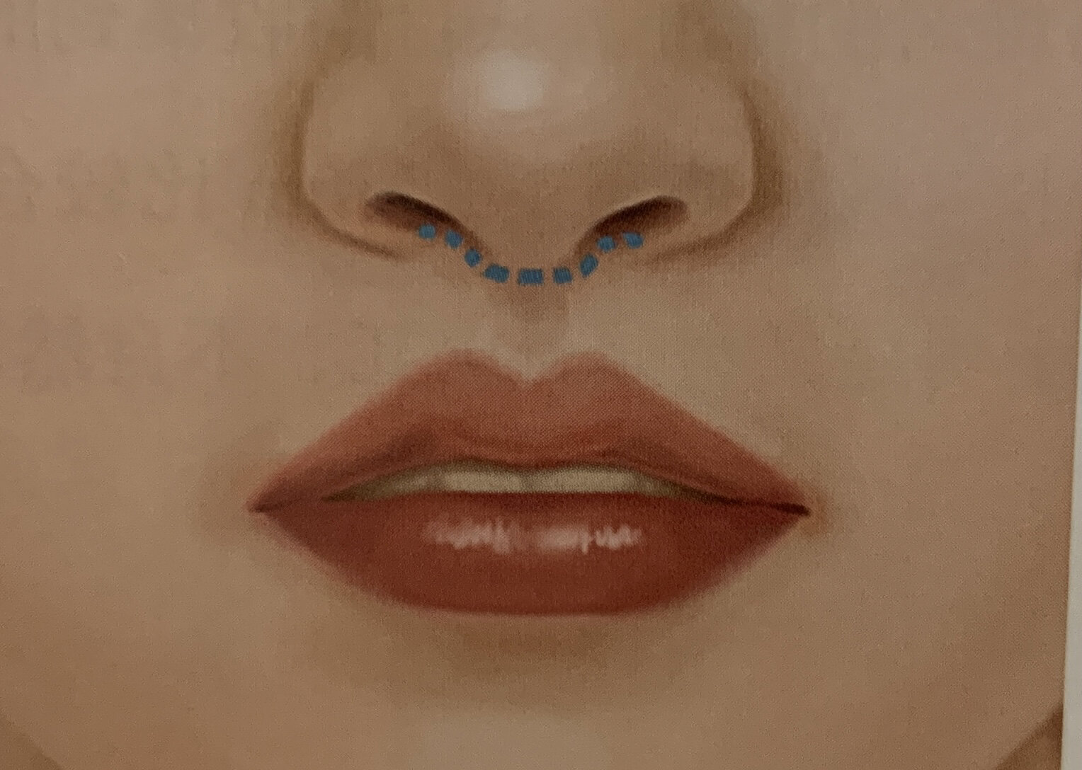 人中延长示意图 人中延长手术设计原理: 沿鼻小柱,双侧鼻槛,双侧鼻翼