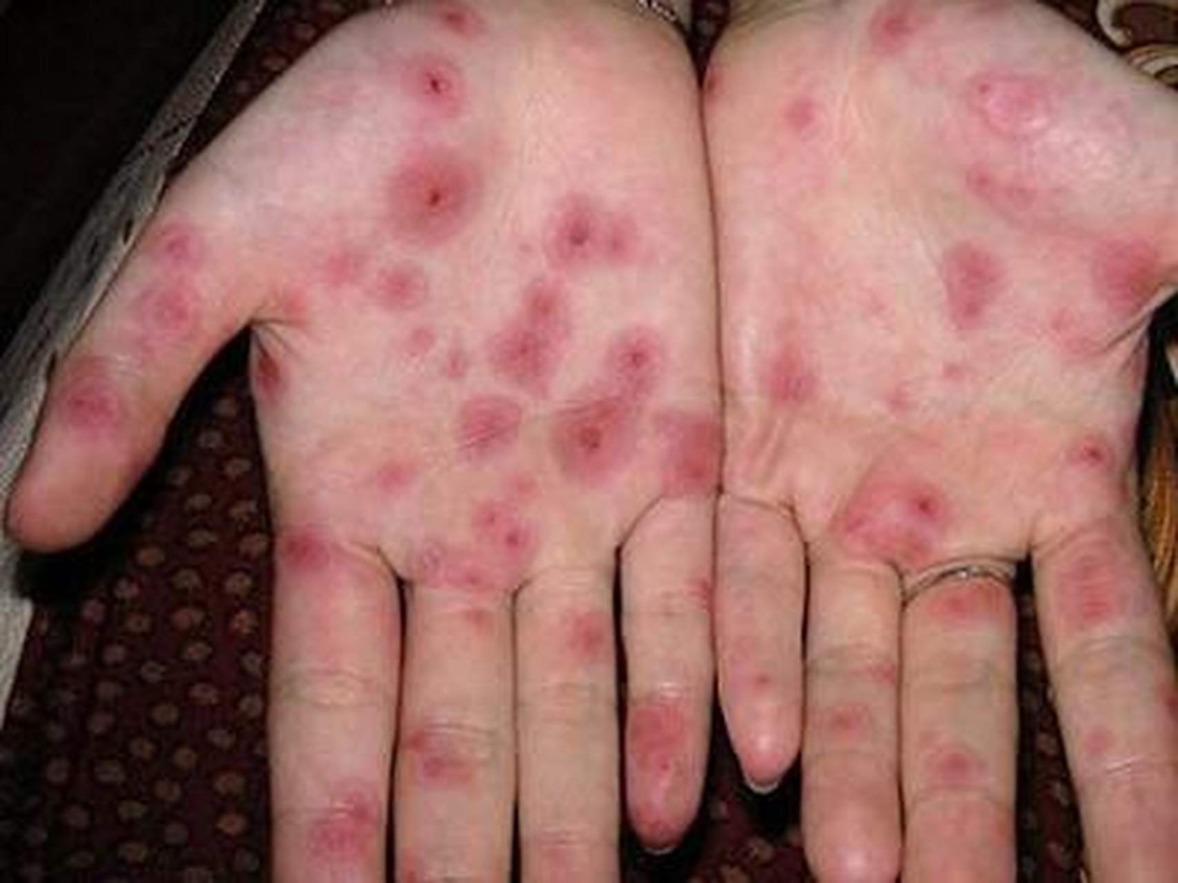 梅毒早期症状,都有哪些?注意这3点!