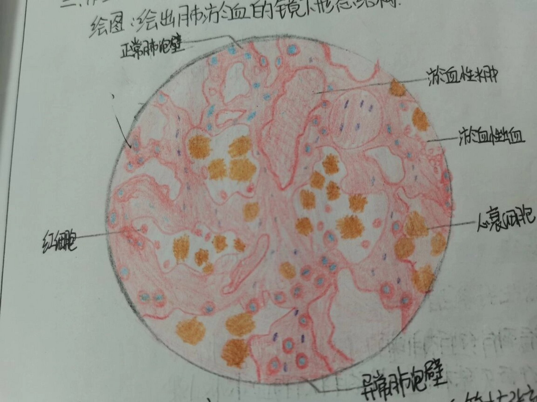 病理切片-肺瘀血,肝瘀血 肺淤血 诊断描述:1,肺内小静脉和毛细血管
