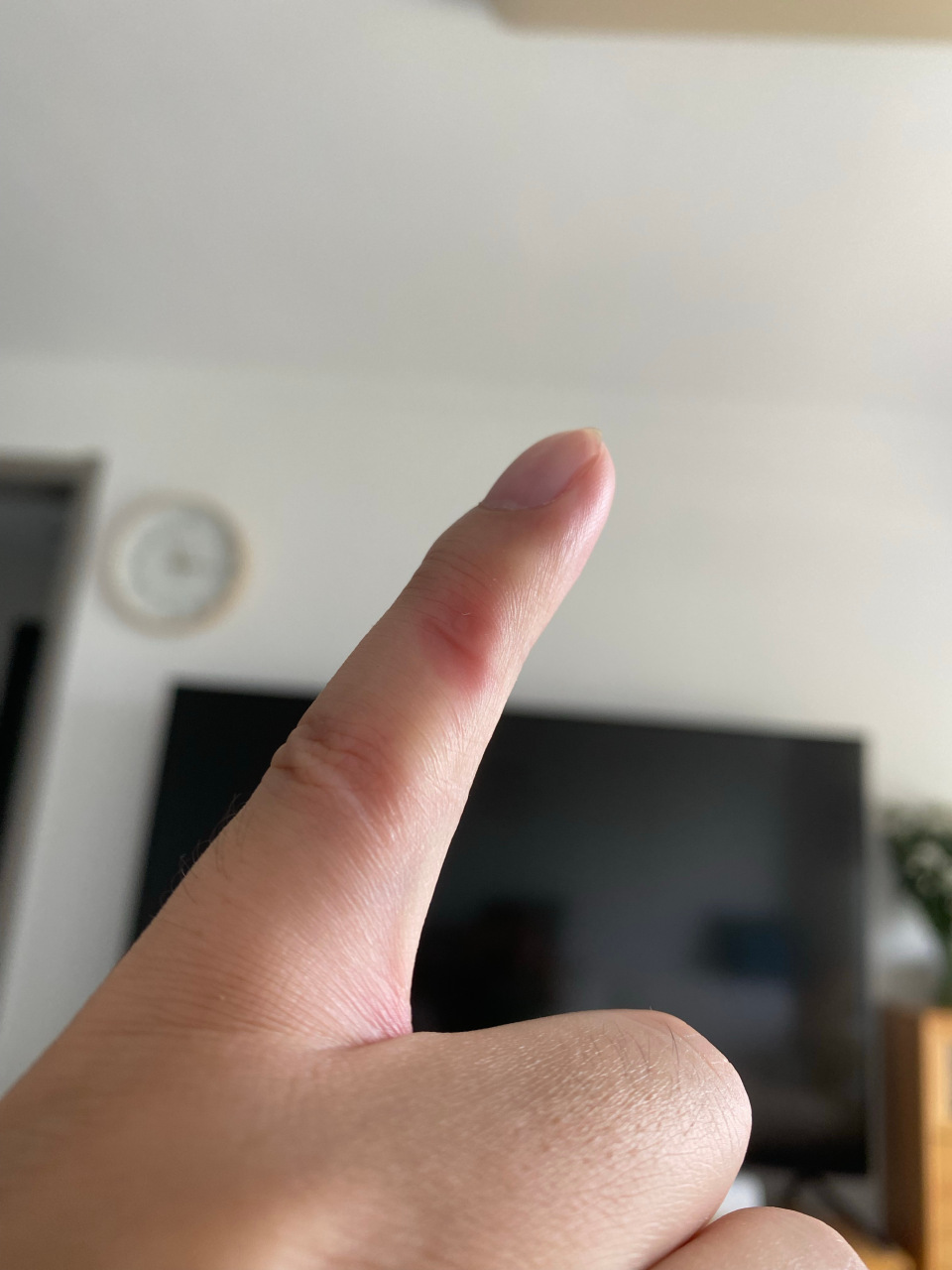 长期玩手机有哪些后遗症这就是我的后遗症.小拇指已经凹陷发红.