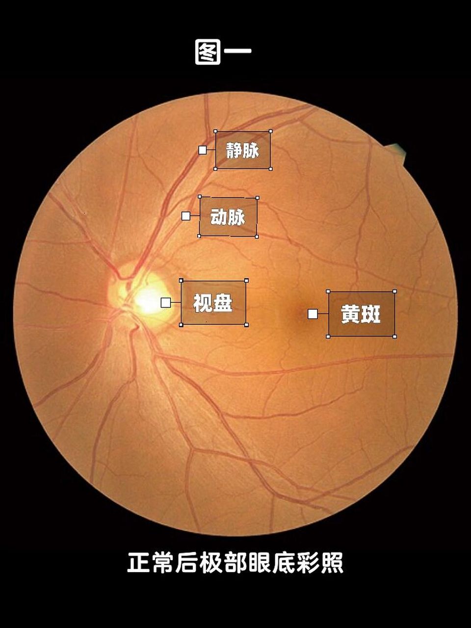 一分钟秒懂常见眼底报告解读,家长必看 96 家长带孩子去拍了眼底照