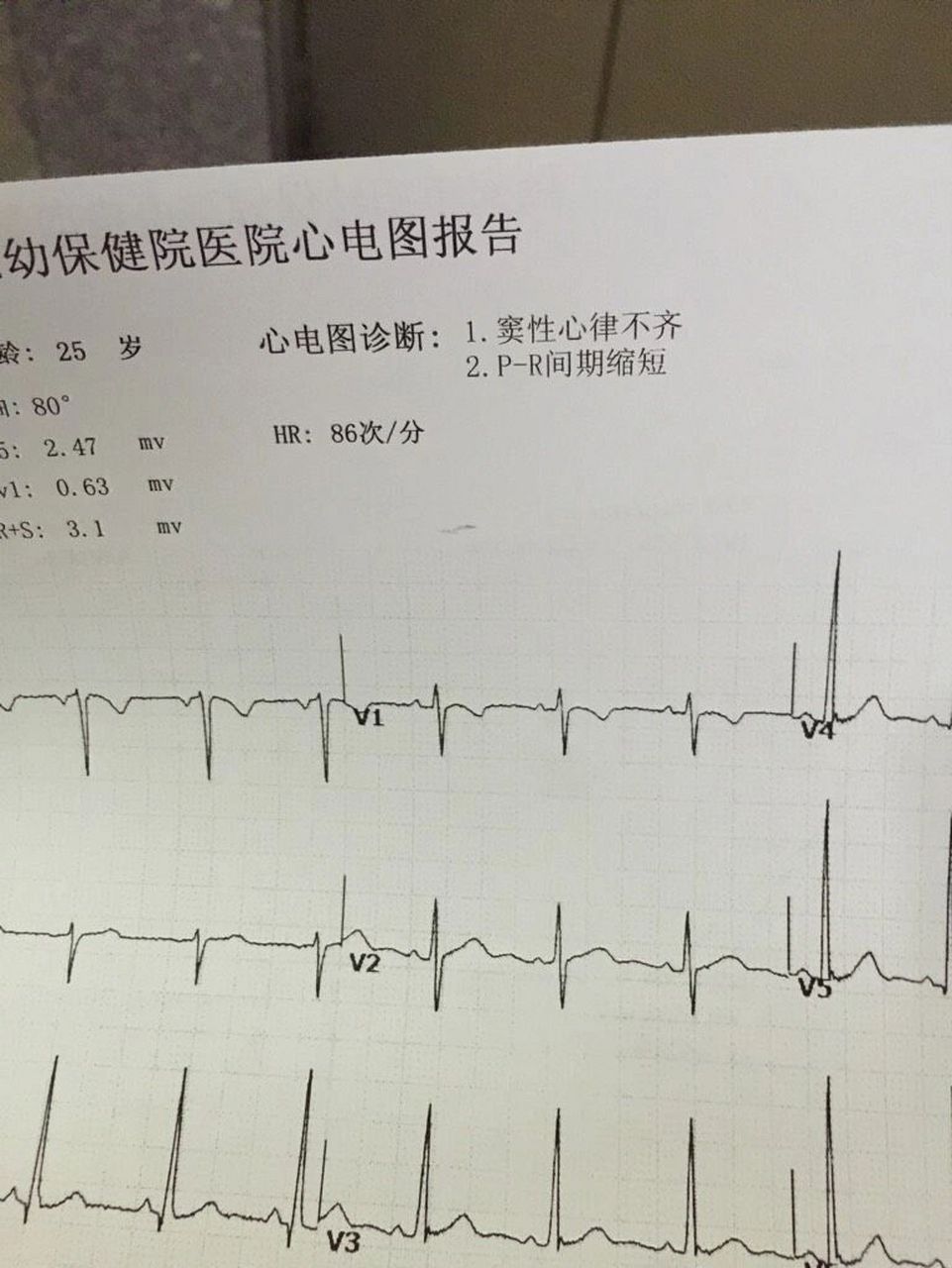 今天我跟大家说说什么是窦性心律不齐