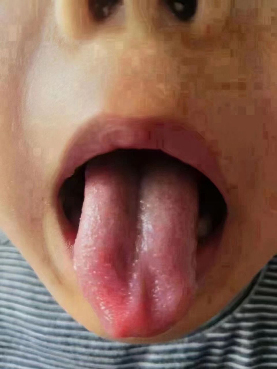 很多小朋友,舌头中间有一条深深地凹陷60 很多小朋友, 舌头中间有一