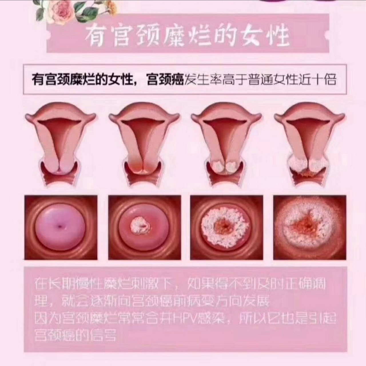 ②宫颈糜烂二度∷内分泌增多发黄,有异味,同房时候可能会有血,会疼!