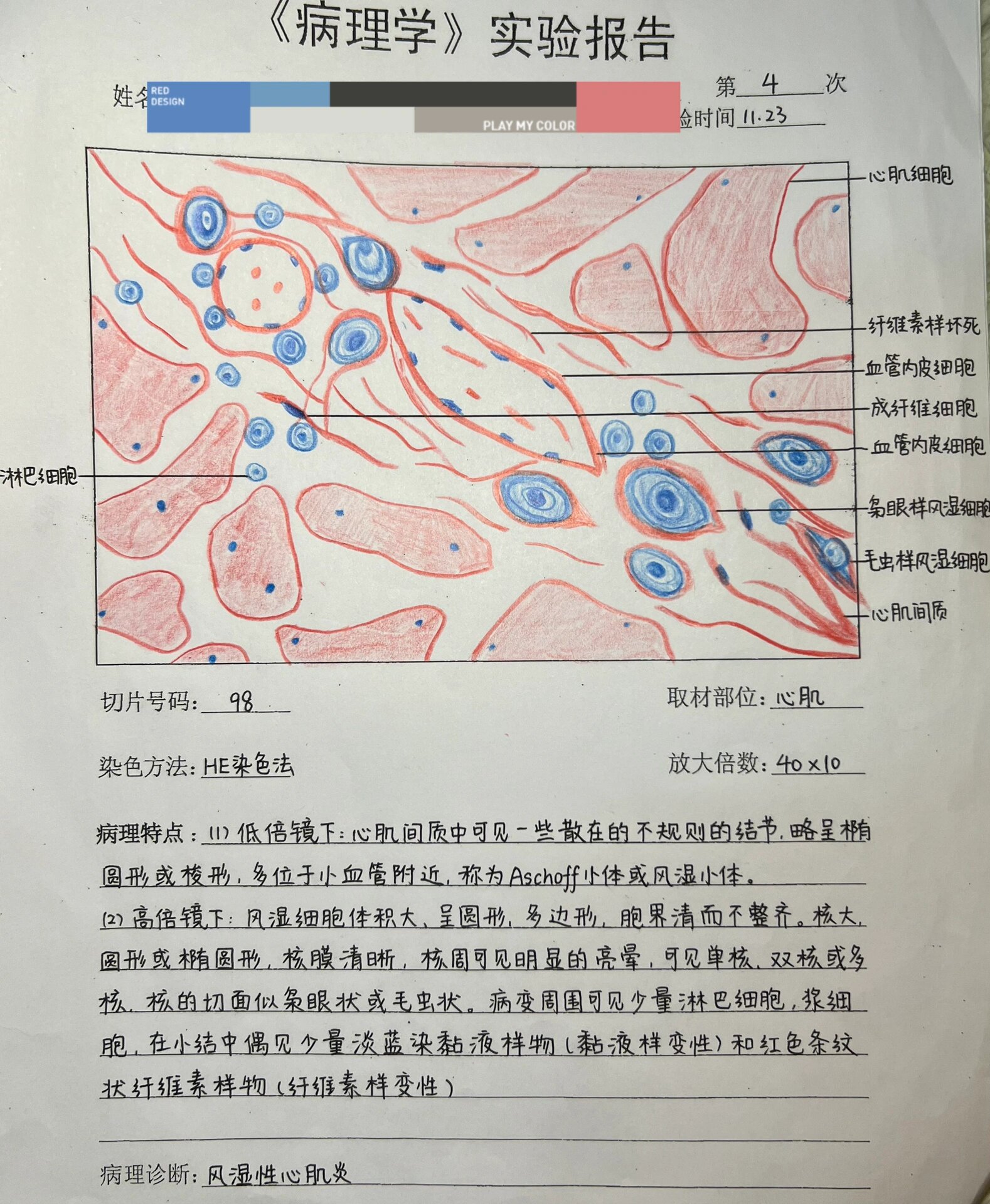 风湿性心肌炎病理图片