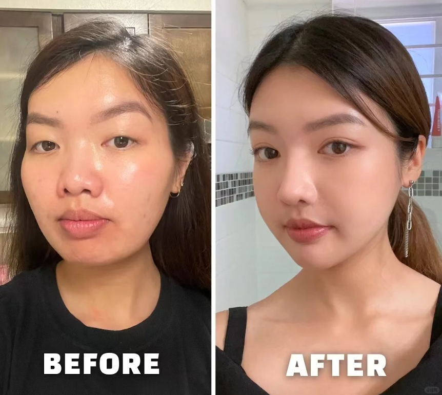 今天分享的宝子觉得自己的鼻子太塌,鼻头很肉,鼻翼缘后缩,露鼻孔明显