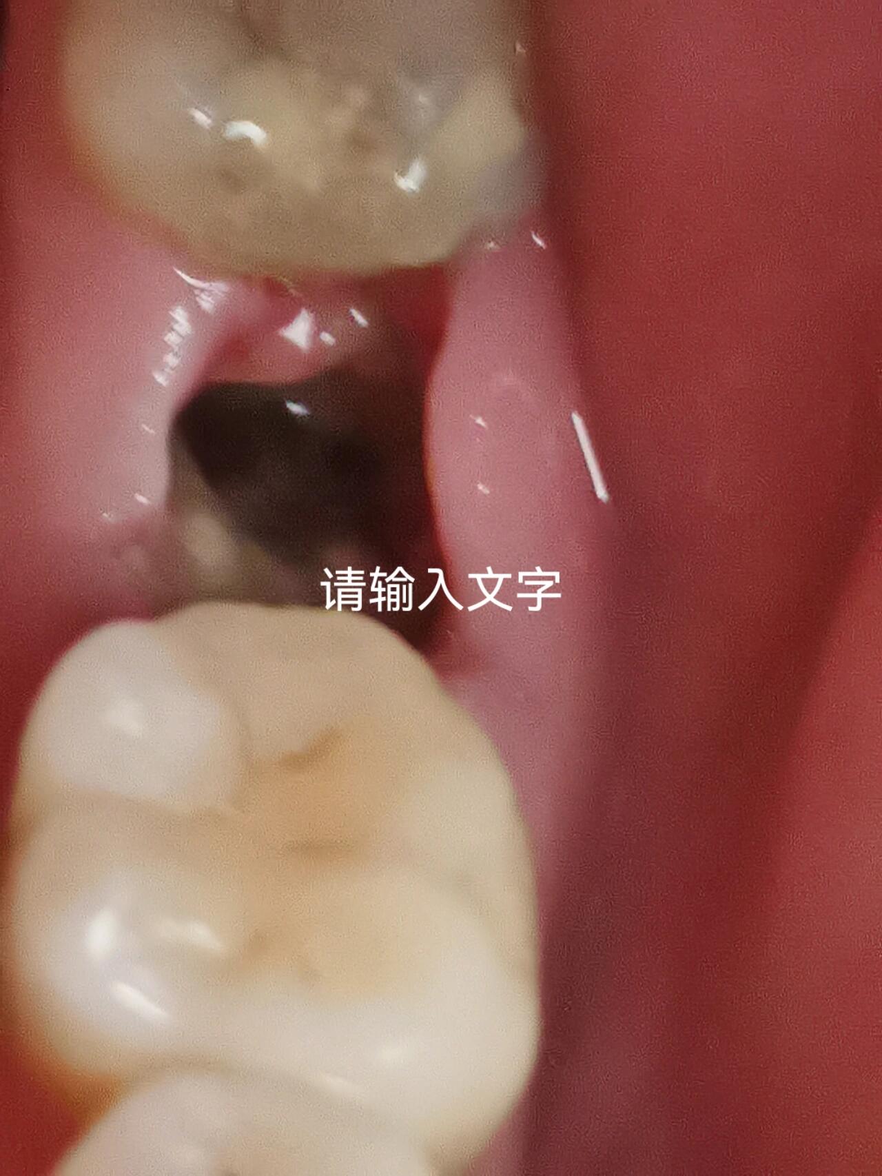 拨牙第五天创面正常吗?害怕得干槽症