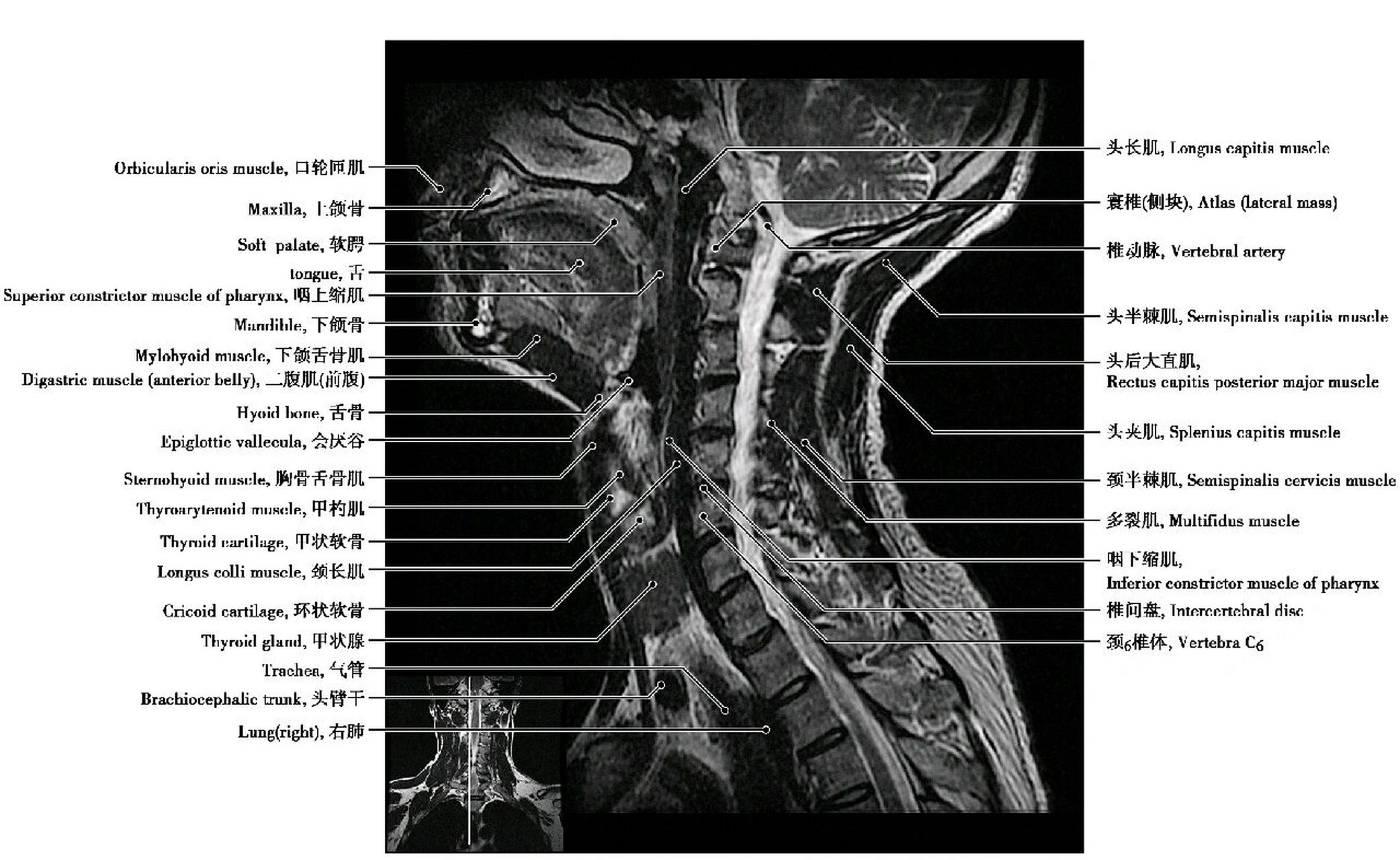 颈椎磁共振图片详解图片