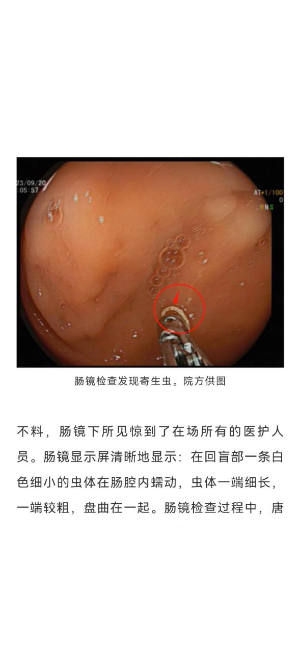 腹の中の寄生虫图片