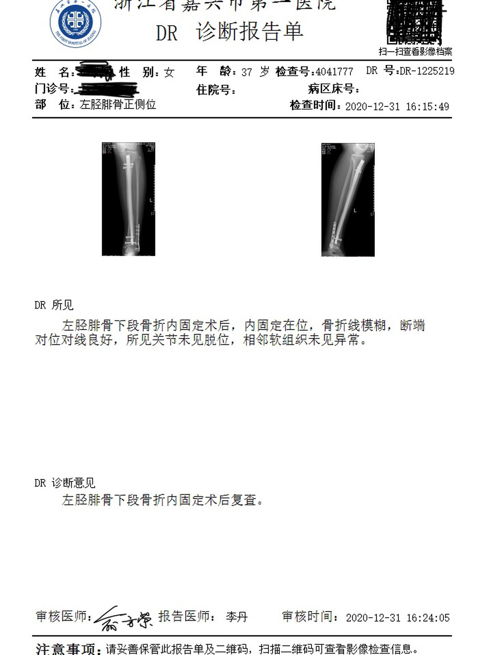 骨折片子 轻微图片