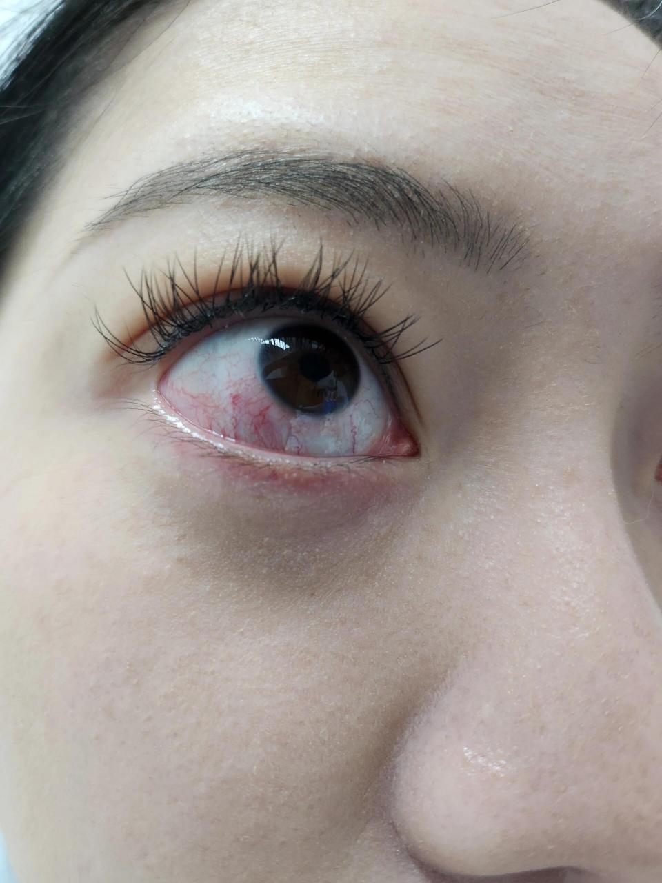 这是结膜炎了吗家人们😭-今天好很多啦!